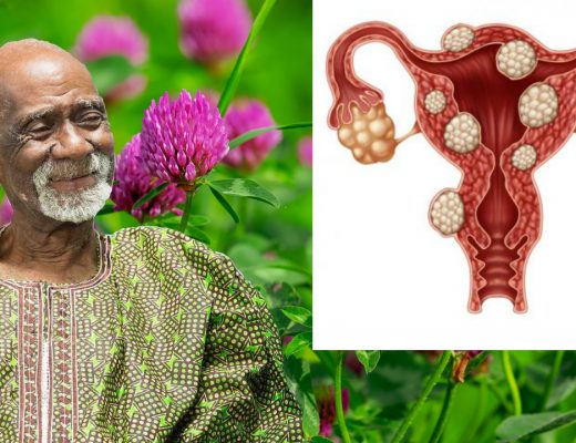 Endometriosis Dr Sebi
