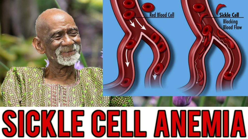 Sickle Cell Anemia Dr Sebi