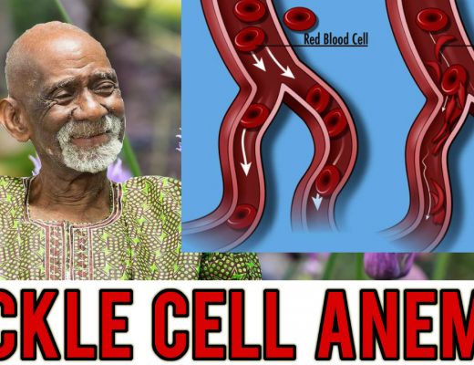 Sickle Cell Anemia Dr Sebi